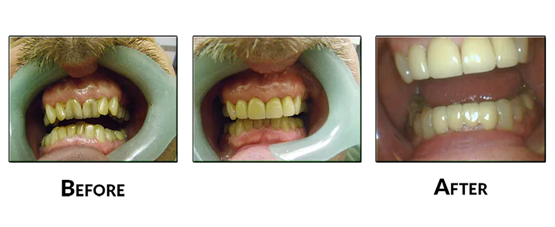 Upper and Lower Crowns