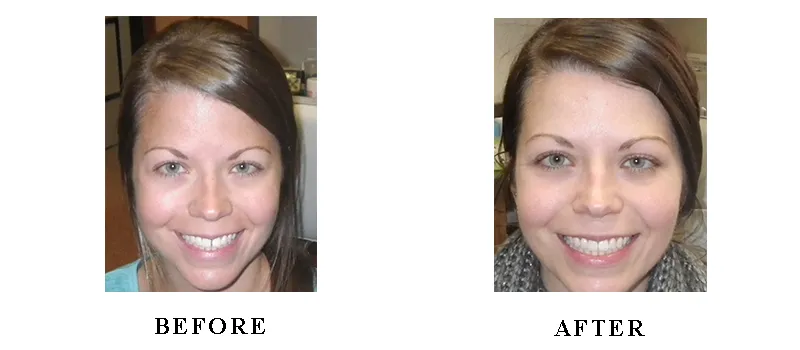 Before & After Invisalign in Monroe, MI