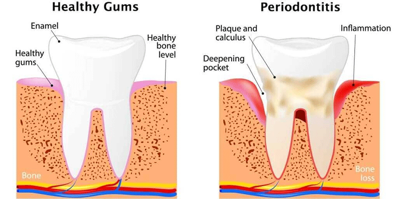 Gum Disease Specialists