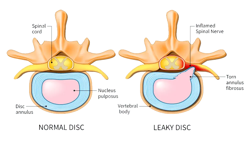 leaky disc