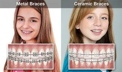 Orthodontic Appliance Options.