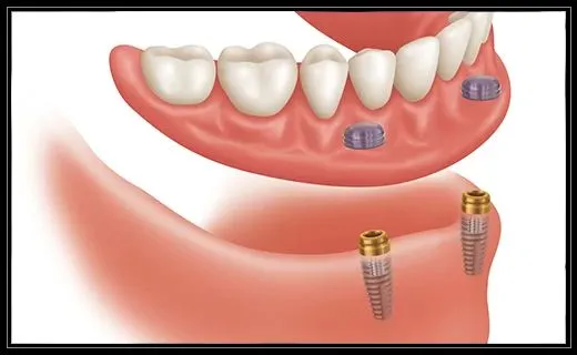 Snap-on-dentures