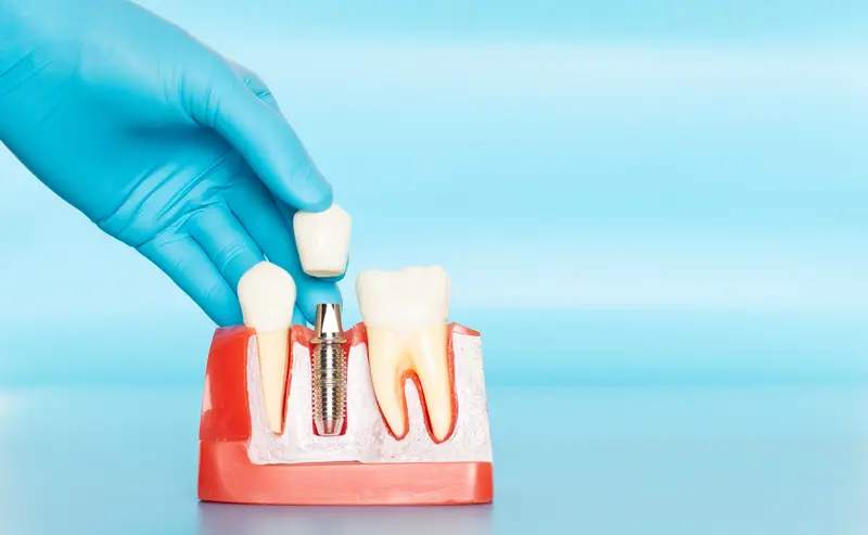 hand wearing medical glove placing dental crown on mouth model with embedded implant post, dental implants Gardnerville, NV dentist