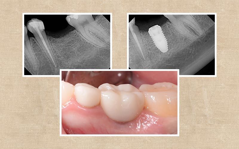 Implants