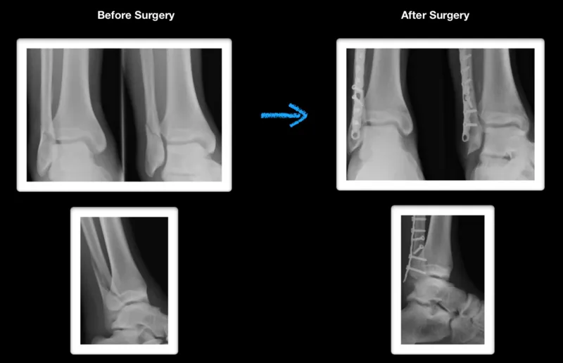 Fibula Fractures Robert Sheinberg, DPM Weston, FL Podiatrist