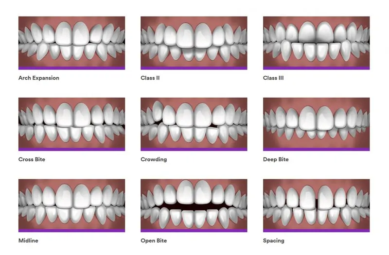 Aligners: A Dental Treatment That Can Help You Achieve a Straight