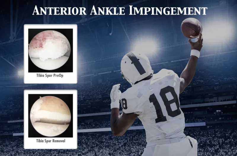 Anterior Ankle Impingement (Footballer's Ankle) Robert Sheinberg, DPM