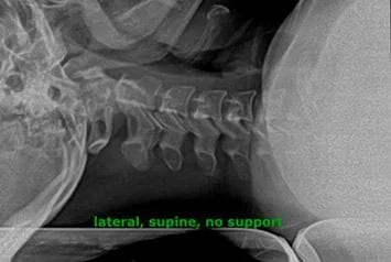 X Ray No Spine & Head Support