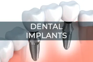 Dental Implant