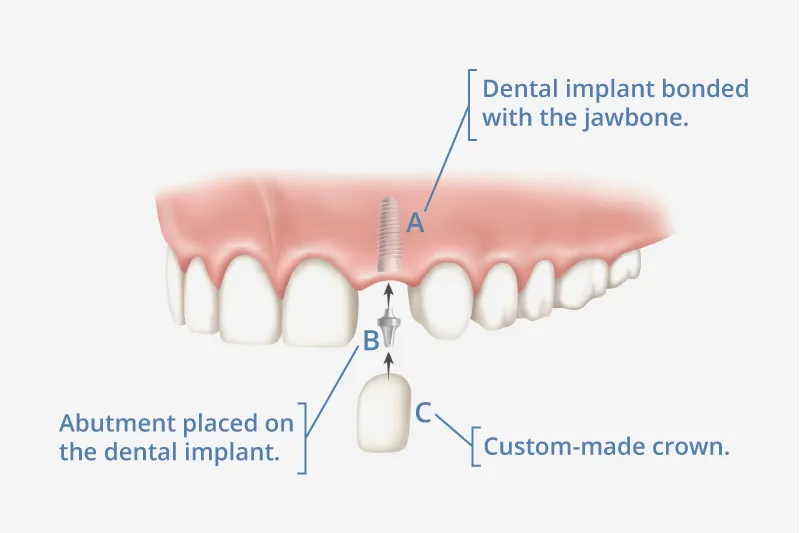 Dental Implants in Mt Pleasant 