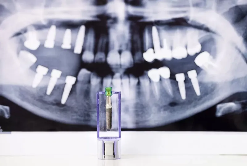 dental-implant