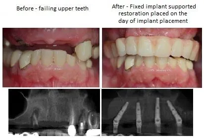 Before And After Implant Denture pics from Alexander Pritsky, DMD in Fresno, CA