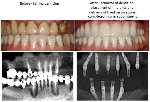 Before And After Implant Denture pics from Alexander Pritsky, DMD in Fresno, CA