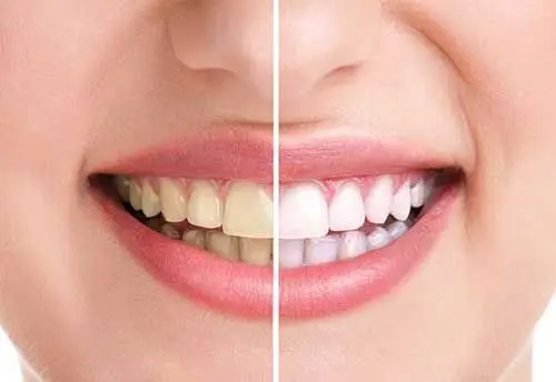 Fort Myers FL Teeth Whitening