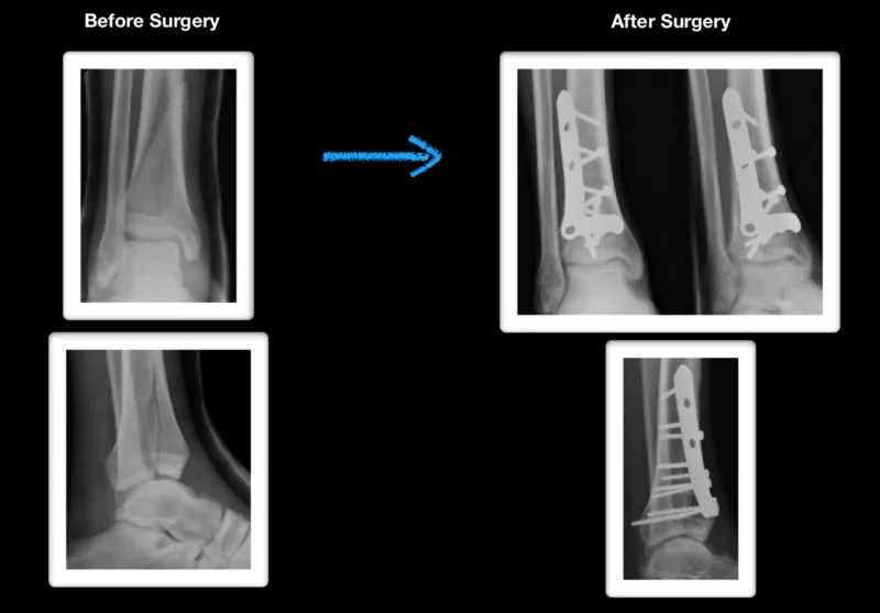 Pilon Fractures Robert Sheinberg, DPM Weston, FL Podiatrist
