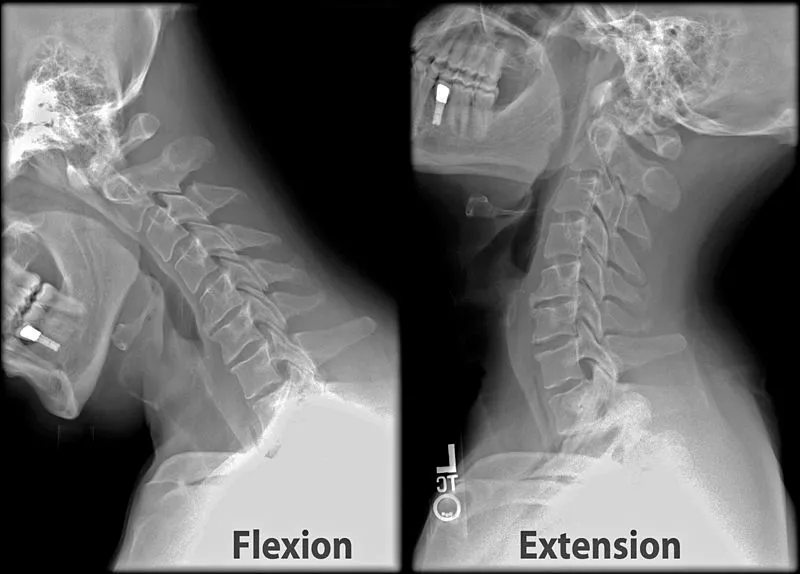 Flexion / Extension X-rays of the Cervical Spine