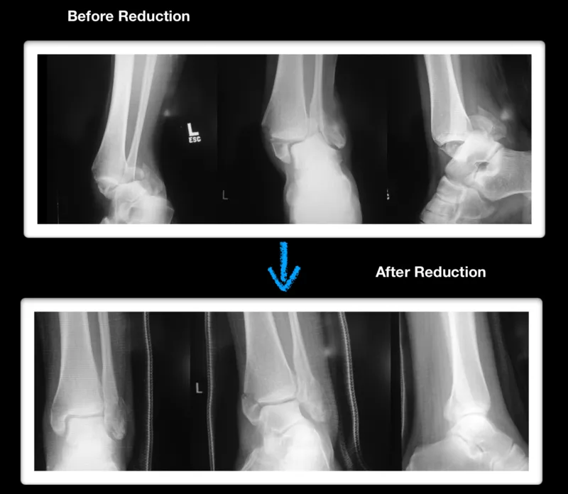 Trimalleolar Fractures Robert Sheinberg DPM Weston FL Podiatrist