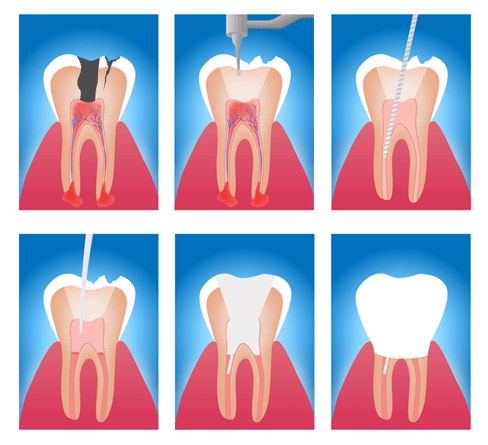 Illustration of root canal