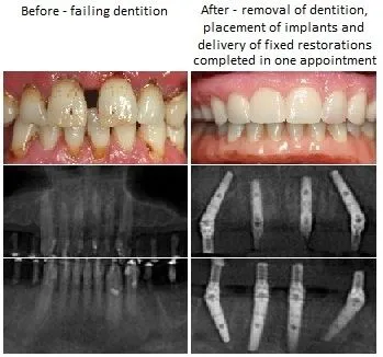 Before And After Implant Denture pics from Alexander Pritsky, DMD in Fresno, CA