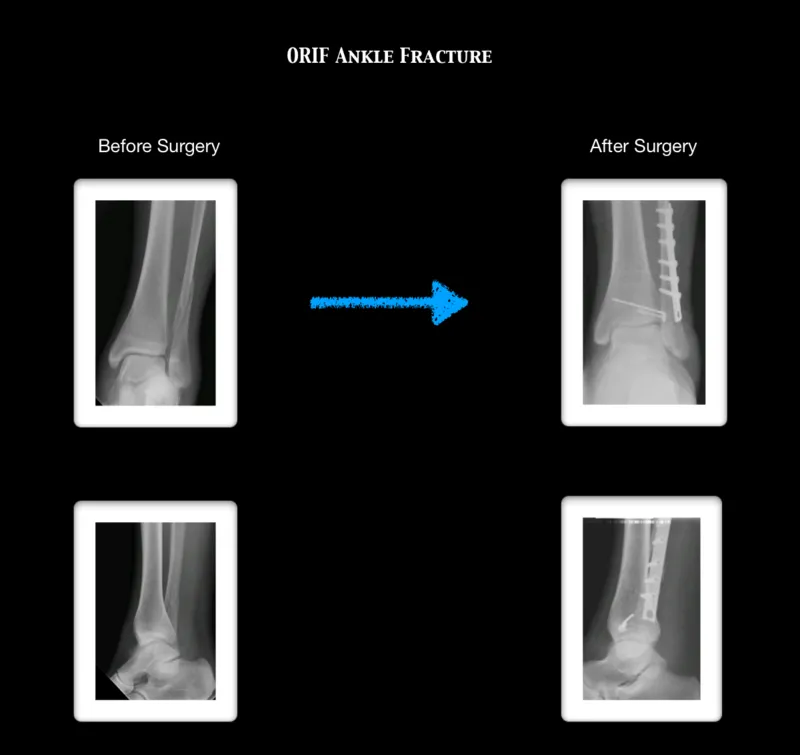 ORIF Ankle Fracture/ Foot fracture Protocols, Post-Surgical Timeline