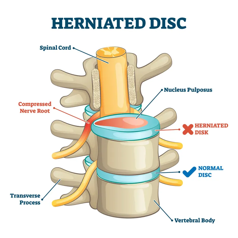 herniated_disc