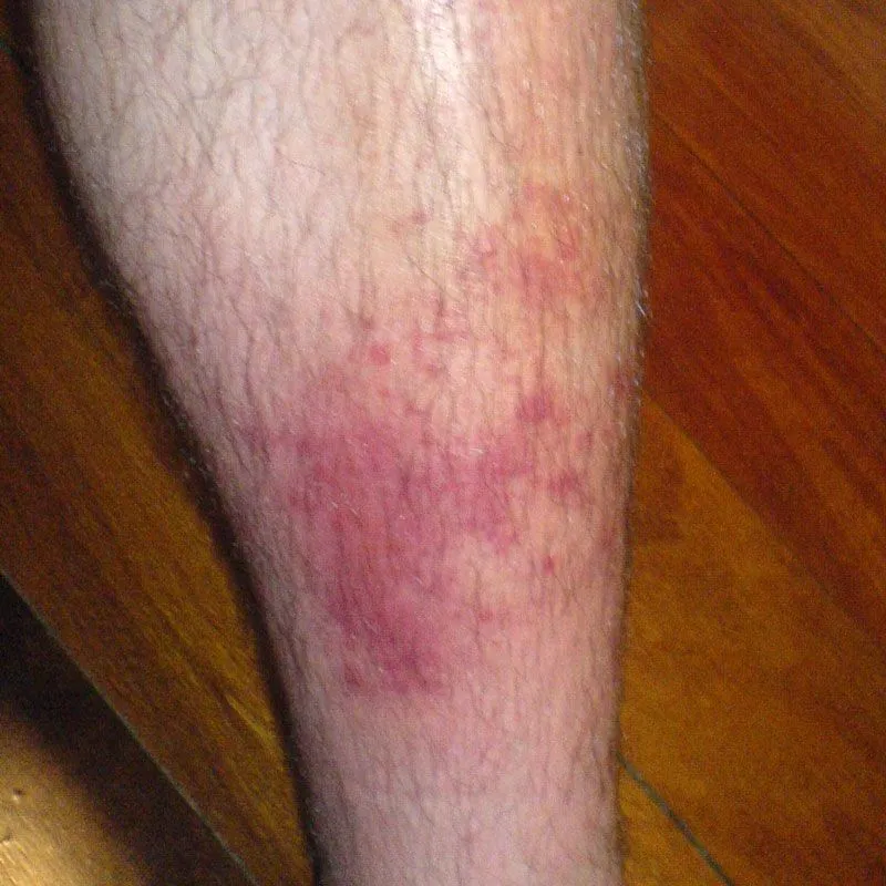 early stages staph infection on leg