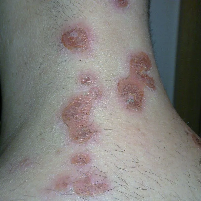 early stages staph infection on leg