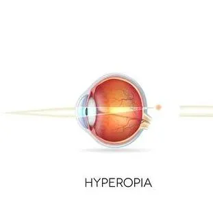 Hyperopia