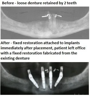 Before And After Implant Denture pics from Alexander Pritsky, DMD in Fresno, CA