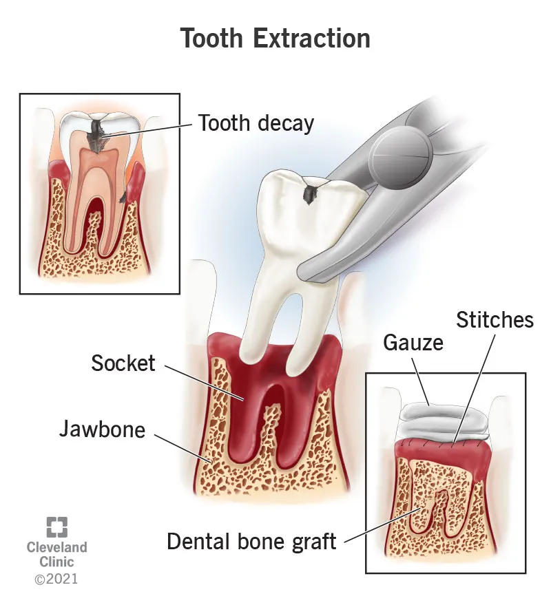 extractions