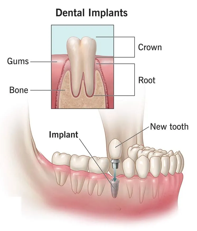 Dental Implants Process Sterling Heights MI