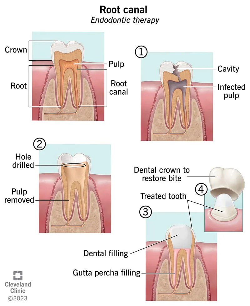 root canals