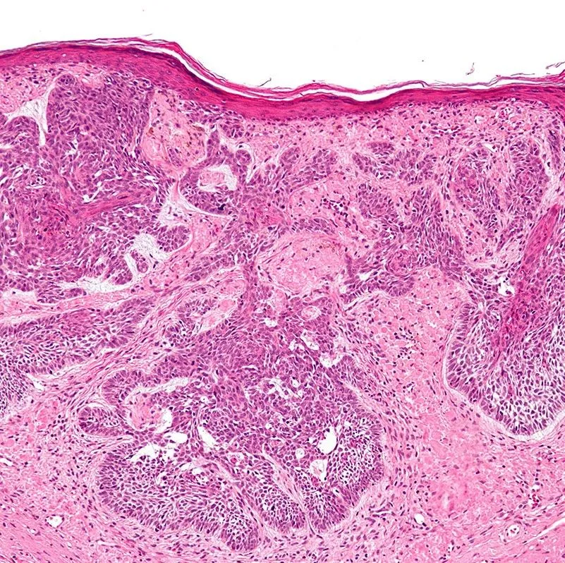 Basal cell carcinoma