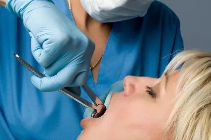 dentist using dental pliers to pull tooth from woman's mouth, tooth extractions Windsor Locks, CT dentist