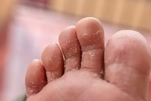 Close-up of a foot affected by athlete's foot