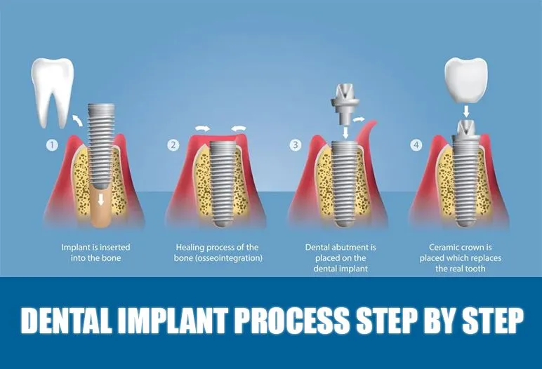 Implant Placement Process