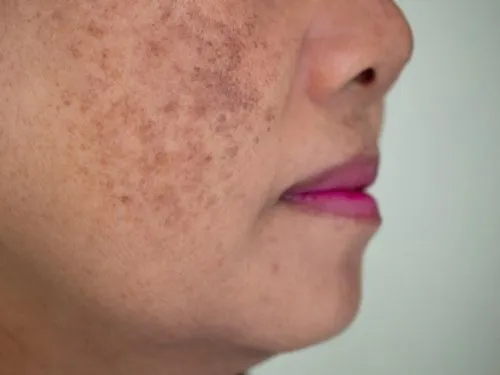Skin condition showing hyperpigmentation on woman's cheeks.