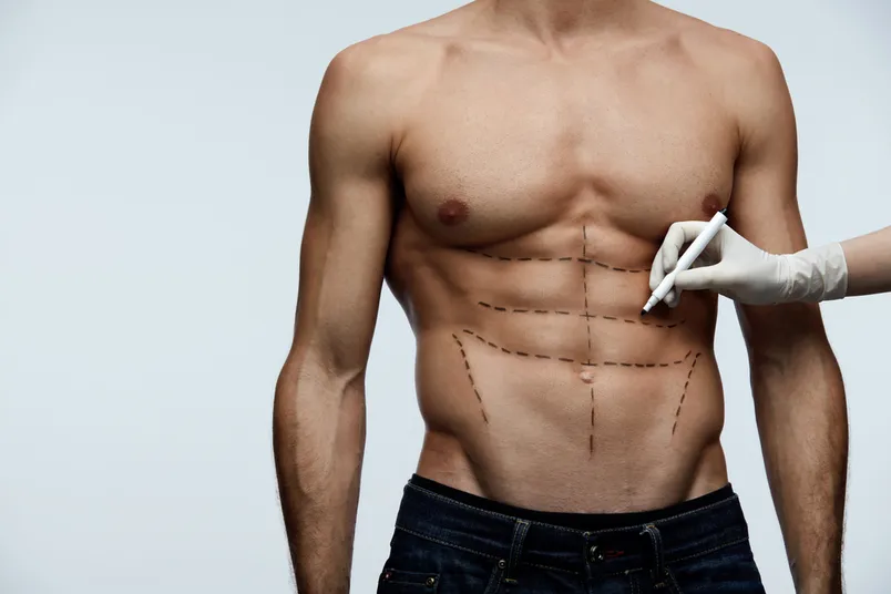 Male Liposuction