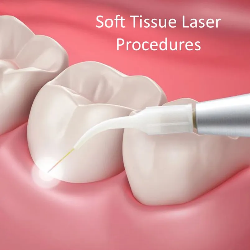 Soft Tissue Laser