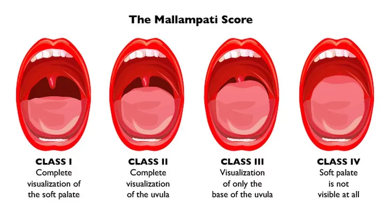 Mallampati Score