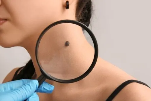 Female patient undergoing mole screening by dermatologist