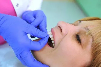 dentist's gloved hand placing veneer piece on woman's tooth, veneers Houston, TX dentist