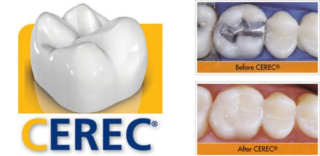 cerec single visit crownsgle visit crowns