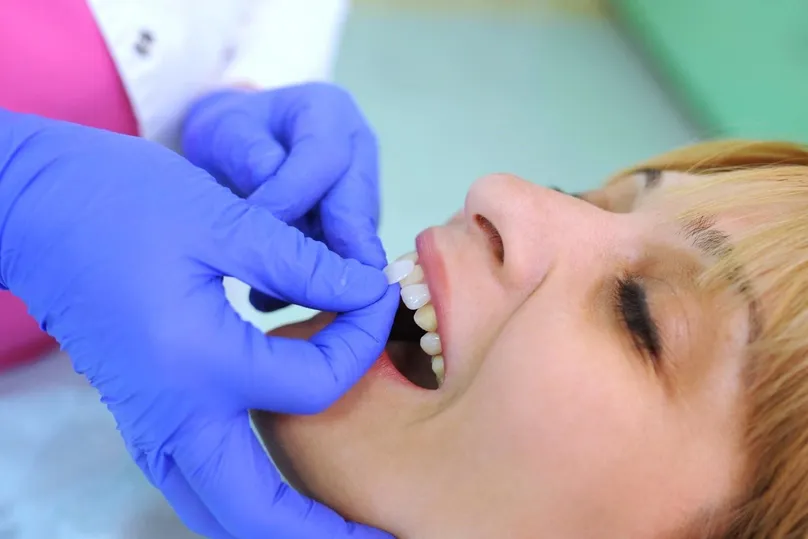 gloved dentist's hands placing veneer pieces on woman's front teeth, veneers Mt Airy, NC cosmetic dentistry