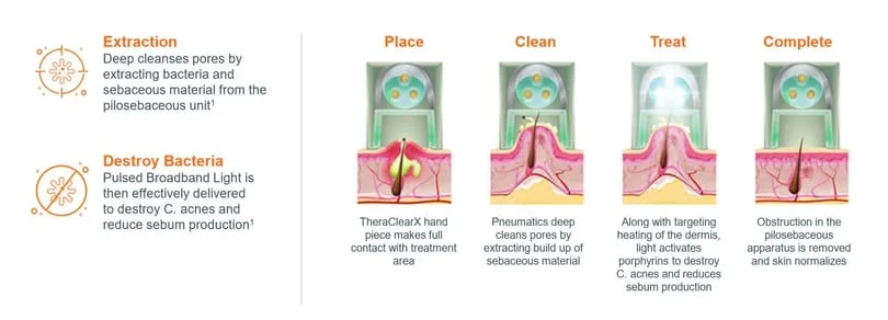 Acne Treatment Process