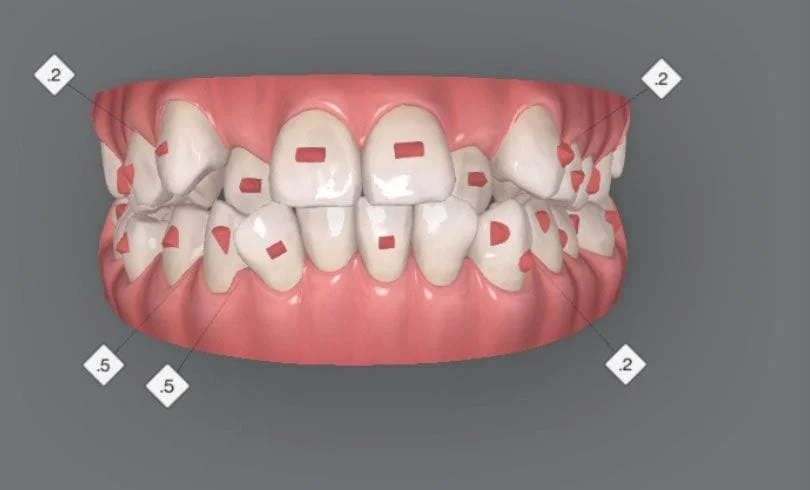 before and after invisalign treatment simulation