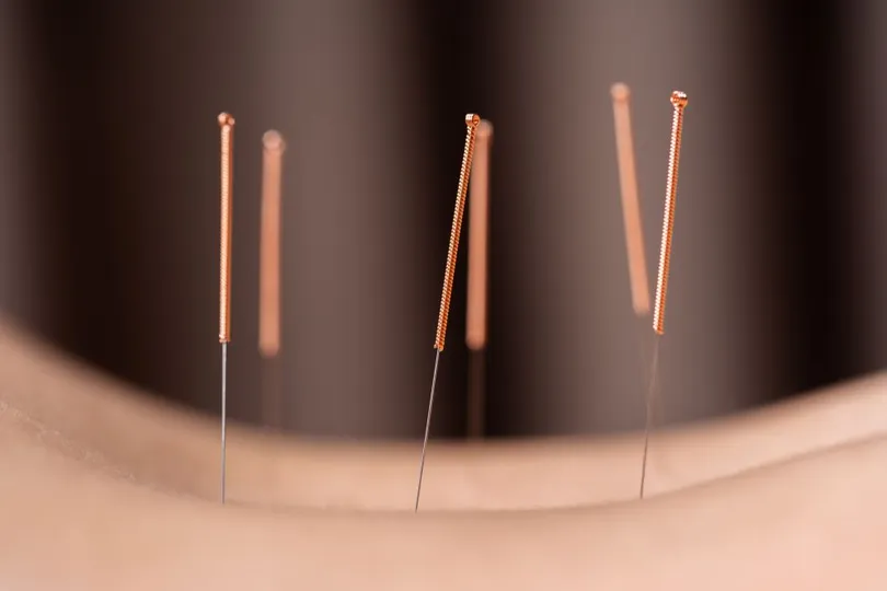 acupuncture