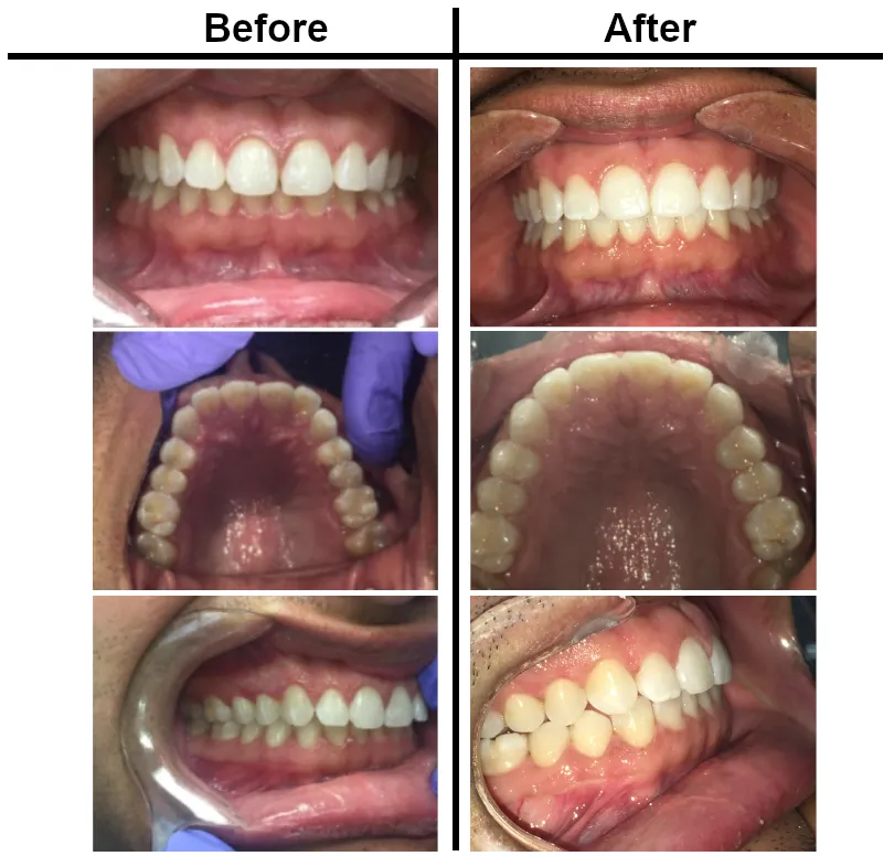 Invisalign Before and After Photos in Bakersfield, CA