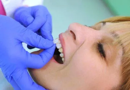 dentist's gloved hands placing veneer pieces onto woman's front teeth, dental veneers Bradenton, FL cosmetic dentistry