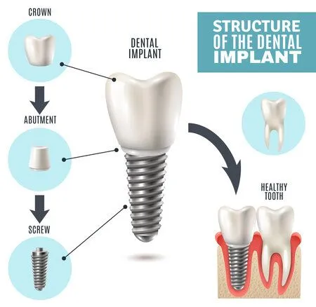 Illustrated diagram "Structure of the Dental Implant" showing implant parts and placement in gums, dental implants Plainfield, IL dental implant dentist